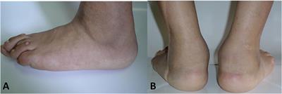 Inflammatory Foot Involvement in Spondyloarthritis: From Tarsitis to Ankylosing Tarsitis